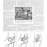 0827 - Page 823 - Travaux originaux. L'ostéotomie courbe de l'os coxal comme traitement de l'ankylose de la hanche vicieusement consolidée. Procédé personnel. Par Al. D. Radulesco...