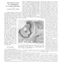 0877 - Page 873 - Travaux originaux. Bronchectasie et thrombose de l'artère bronchique. Par MM. P. Ameuille et J.-M. Lemoine