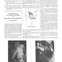 0919 - Page 915 - Travaux originaux. Hypertension artérielle permanente et glande endocrines. Par MM. Paul Halbron... et H-Pierre Klotz... Bibliographie / Transformation en chondro-sarcome d'une maladie ostéogénique. Par Robert-Didier