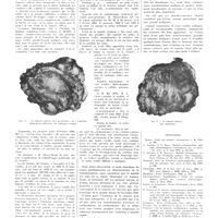 0920 - Page 916 - Transformation en chondro-sarcome d'une maladie ostéogénique. Par Robert-Didier / Bibliographie