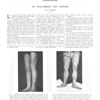 0941 - Page 937 - Travaux originaux. Le traitement des varices. Par P. Alglave