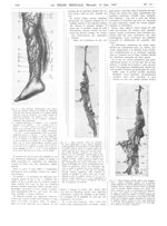 Fig. 3. Pour mémoire : Photographie d'une dissection d'un membre variqueux sur lequel un chirurgien  [...]