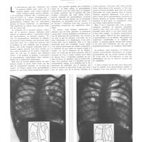 0950 - Page 946 - Travaux originaux. Le pneumothorax contro-latéral. Par MM. Tobé, Degeorges, Salmon et Joly...