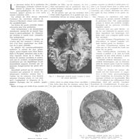 0955 - Page 951 - Travaux originaux. Contributions à l'étude physio-pathologique des hémorragies cérébrales. Par MM. D. Paulian et I. Bistriceano