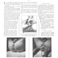 0958 - Page 954 - Travaux originaux. Fistules anales. Traitement ambulatoire des extra-sphinctériennes plus particulièrement. Par Robert Kaufmann