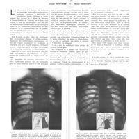 1075 - Page 1065 - Travaux originaux. Syndrome artériel pulmonaire dans la sinistrocardie. Par MM. Joseph Génévrier et Hector Descomps
