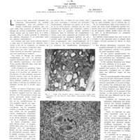 1178 - Page 1172 - Travaux originaux. Traitement des adénites tuberculoses par l'injection intralymphatique de chlorophylle formolée en solution éthérée. Par MM. Paul Moure..., Baude... et Ch. Rouault...