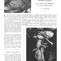 1181 - Page 1175 - Travaux originaux. Thrombo-phlébite de la veine cave inférieure et de la veine porte. Par R. Lutembacher