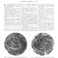 1195 - Page 1189 - Travaux originaux. Sur la glomérulonéphrite diffuse subaiguë (Forme extracapillaire). Par H. Chabanier, C. Lobo-Onell et E. Lelu
