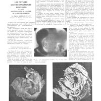 1255 - Page 1249 - Travaux originaux. Les fistules gastro-duodénales spontanées au cours de l'évolution de l'ulcère de la petite courbure. Par Pierre Moiroud...