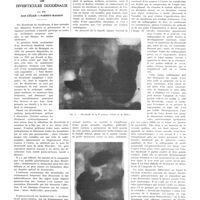 1317 - Page 1313 - Travaux originaux. Les diverticules duodénaux. Par MM. Jean Célice et Parrot-Manson