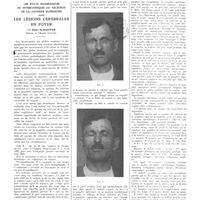 1395 - Page 1393 - Travaux originaux. Les états spasmodiques ou hypertoniques du releveur de la paupière supérieure dans les lésions cérébrales en foyer. Par Henri Schaeffer...