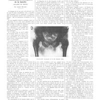 1483 - Page 1483 - Petites cliniques de «La presse médicale». N° 341. Ostéochondrite disséquante de la hanche (Maladie de Koenig). Par Albert Mouchet