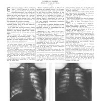 1549 - Page 1551 - Travaux originaux. Le traitement des abcès du poumon par les injections d'alcool intraveineuses. Par MM. R. Simon et E. Magrou...