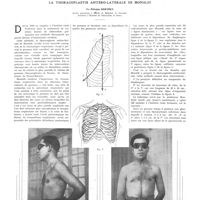 1556 - Page 1558 - Travaux originaux. Une nouvelle méthode chirurgicale dans le traitement de la tuberculose pulmonaire : la thoracoplastie antéro-latérale de Monaldi. Par Étienne Berthet...