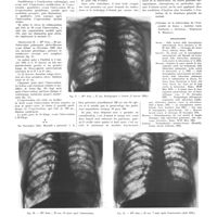 1558 - Page 1560 - Travaux originaux. Une nouvelle méthode chirurgicale dans le traitement de la tuberculose pulmonaire : la thoracoplastie antéro-latérale de Monaldi. Par Étienne Berthet... / Bibliographie