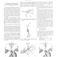 1655 - Page 1659 - Notes de médecine pratique. Publiées par les soins de A. Ravina. Le traitement de la fissure anale par des injections péri-fissuraires