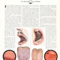 1795 - Page 1801 - Travaux originaux. Langue et estomac. Par MM. Paul Chevallier et François moutier