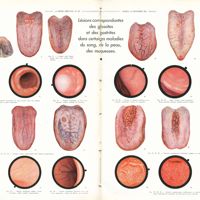 1796 - Page 1802-1803 - Travaux originaux. Langue et estomac. Par MM. Paul Chevallier et François moutier / Lésions correspondantes des glossites et des gastrites dans certaines maladies du sang, de la peau, des muqueuses