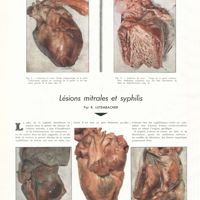1823 - Page 1830 - Travaux originaux. Intérêt pratique d'une classification anatomo-pathologique des néphrites. Par MM. H. Chabanier et C. Lobo-Onell / Lésions mitrales et syphilis. Par R. Lutembacher