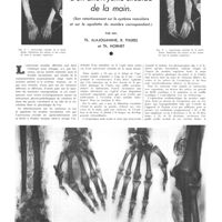 1828 - Page 1835 - Travaux originaux. Étude anatomo-clinique d'un anévrysme cirsoïde de la main. (Son retentissement sur le système vasculaire et sur le squelette du membre correspondant). Par MM. Th. Alajouanine, R. Thurel et Th. Hornet