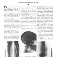 1835 - Page 1842 - Travaux originaux. Ostéite fibreuse déformante de Paget et sarcome. Par MM. Paul Banzet, Jacques Delarue, Al. Elbim
