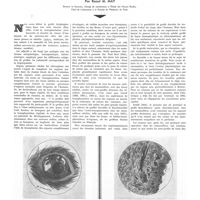 1844 - Page 1851 - Travaux originaux. La greffe bréphoplastique. Par Raoul M. May...