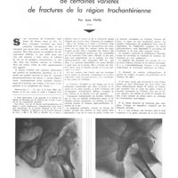 1848 - Page 1855 - Travaux originaux. Remarques sur le traitement chirurgical de certaines variétés de fractures de la région trochantérienne. Par Jean Patel...