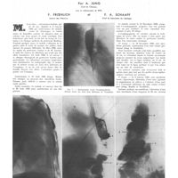 1852 - Page 1859 - Travaux originaux. Oesophagoplastie préthoracique pour sténose cicatricielle de l'oesophage. Par A. Jung... F. Froehlich... et F. A. Schaaff...