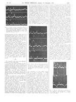 Fig. 3. M. R..., 29 ans ; rétrécissement mitral avec dyspnée d'effort et de décubitus ; hémoptysies  [...]