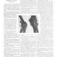1938 - Page 1947 - Petites cliniques de «La presse médicale». N° 349. Ostéochondromatose articulaire du coude. Par Albert Mouchet