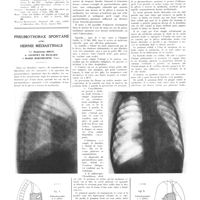 2021 - Page 2032 - Travaux originaux. La syphilis chez les tuberculeux pulmonaires. Par MM. Pierre-Bourgeois et L. Fischer. Bibliographie / Pneumothorax spontané avec hernie médiastinale. Par Madeleine Brun, A. Jaubert de Beaujeau et Marie Berthezene...