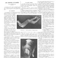 2042 - Page 2053 - Travaux originaux. À côté des parakératoses dermatoses de sensibilisation n'existe-t-il pas des sporiasis maladies à ultra-virus ? Par MM. A. Desaux et H. Prétet / Les greffes cutanées. Par M. Grinda...