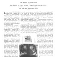 2054 - Page 2065 - Travaux originaux. Les aspects radiologiques de la lésion initiale de la tuberculose pulmonaire. Par MM. Robert Debré, Marcel Lelong et Marcel Mignon