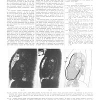 2064 - Page 2075 - Travaux originaux. Etude anatomo-radiologique de l'appareil cardio-vasculaire au moyen d'injection opaques «post mortem». Par MM. Ch. Laubry, P. Cottenot, D. Routier et R. Heim de Balsac / Bibliographie