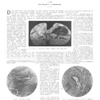 2077 - Page 2088 - Travaux originaux. Nouvelles contributions à l'étude physio-pathologique des hémorragies cérébrales. Par MM. Dem. Paulian et I. V. Bistriceano