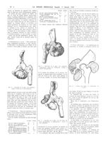 Fig. 3. Dissection de la pièce. Vue antérieure : tumeur sortant par le trou obturateur / Fig. 4. Dis [...]