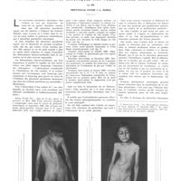 0131 - Page 127 - Travaux originaux. Le traitement chirurgical des pleurésies purulentes chroniques non tuberculeuses chez l'enfant. Par MM. Dreyfus-le Foyer et L. Modec