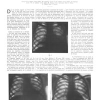 0135 - Page 131 - Travaux originaux. La benzothérapie dans les suppurations gangrènes pulmonaires. Par L. Goldkorn...
