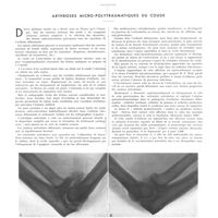 0139 - Page 135 - La radiologie du praticien. Par MM. J. Belot et L. Nahan. Arthroses micro-polytraumatiques du coude