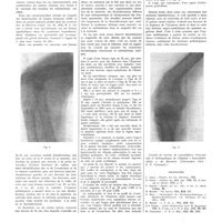 0282 - Page 278 - Travaux originaux. Ostéose thyroïdienne avec fracture spontanée dans un cas de maladie de Basedow. Par MM. F. Gottlieb et M. Schachter-Nancy / Bibliographie