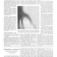 0321 - Page 317 - Travaux originaux. L'ostéo-arthrite sèche trapézo-métacarpienne (Rhizarthrose du pouce). Par Jacques Forestier... / Endoscope et pleurolyse. Quelques conseils pour les débutants. Par Pierre Weiller