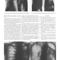 0447 - Page 443 - Travaux originaux. La radiographie limitée à un plan (Tomographie). Son intérêt dans l'étude des lésions pulmonaires. Par MM. Etienne Bernard, Mc Dougall et A. Camino / Bibliographie
