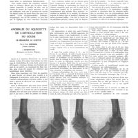 0495 - Page 491 - Travaux originaux. Le foyer congestif tuberculeux rapidement curable. Par MM. Jean Minet, H. Warembourg et Delannoy... / Anomalie du squelette de l'articulation du coude. Os sésamoïde du cubitus. Par le Prof. Kienbök... et Desenfans...