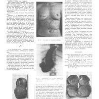 0689 - Page 685 - Travaux originaux. Kystes hydatiques de la rate splénectomie. Par P. L. Mirizzi... / Bibliographie
