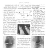 0774 - Page 770 - Travaux originaux. Syndrome héréditaire caractérisé par une hypoplasie des rotules, une malformation des radius et une hémi-atrophie de l'ongle du pouce. Par MM. R. Montant et A. Eggermann