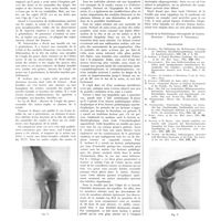 0776 - Page 772 - Travaux originaux. Syndrome héréditaire caractérisé par une hypoplasie des rotules, une malformation des radius et une hémi-atrophie de l'ongle du pouce. Par MM. R. Montant et A. Eggermann / Bibliographie