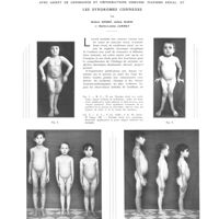 0917 - Page 913 - Travaux originaux. La néphrite chronique atrophique de l'enfance avec arrêt de croissance et déformation osseuses (nanisme rénal) et les syndromes connexes. Par Robert Debré, Julien Marie et Marie-Louise Jammet