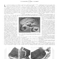 0922 - Page 918 - Travaux originaux. Cysticercose méningée (considérations sur les arachnoïdites). Par MM. Th. Alajouanine, R. Thurel et Th. Hornet