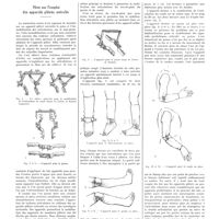 0983 - Page 981 - Notes de médecine pratique publiées par les soins de A. Ravina. Note sur l'emploi des appareils plâtrés articulés